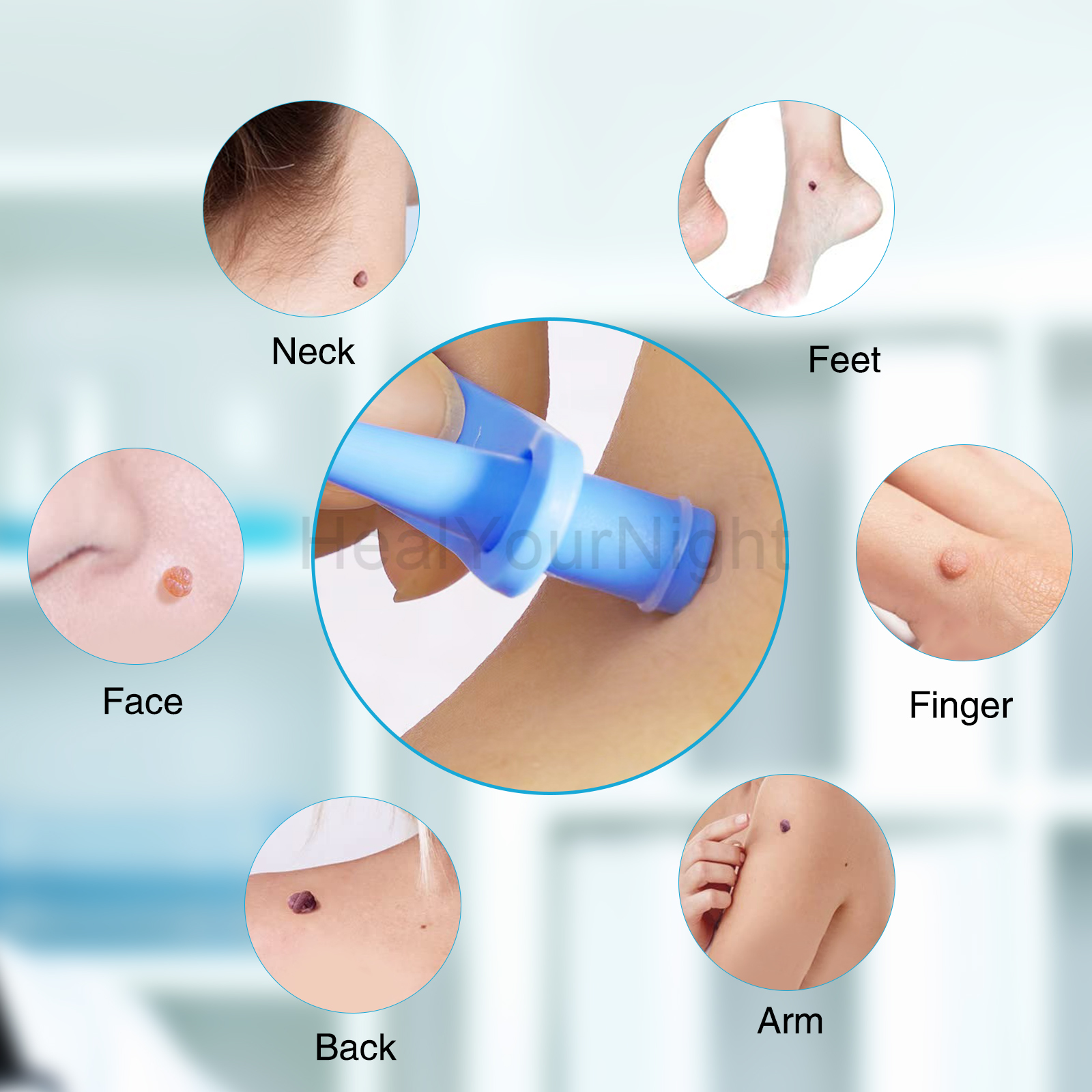 3-IN-1 Auto Skin Tag Removal K - Luxury Skincare Acne ulasan dan harga