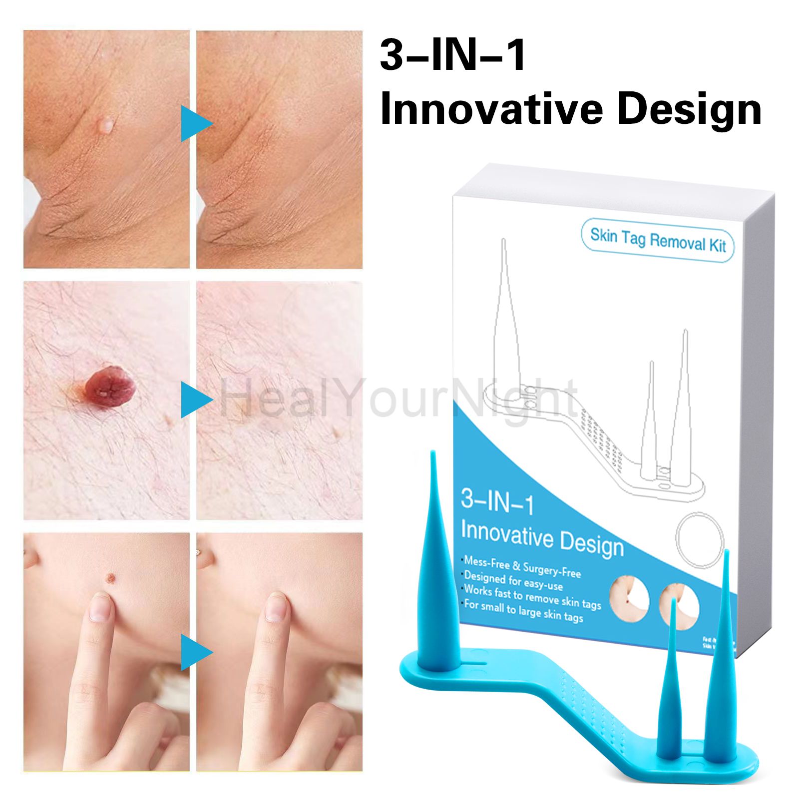 3-IN-1 Auto Skin Tag Removal K - Luxury Skincare Acne ulasan dan harga