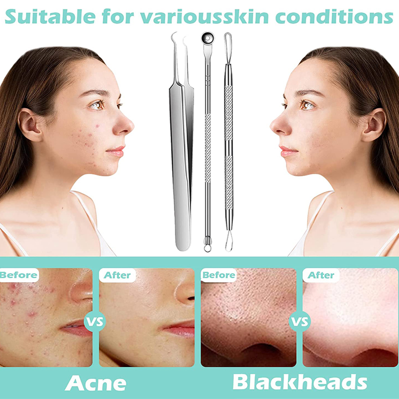 Acne Blackhead Removal Needles - Luxury Skincare Acne ulasan dan harga